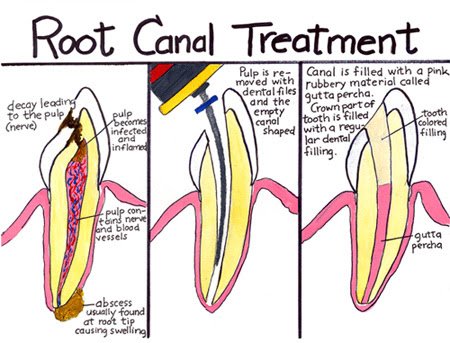 canal treatment